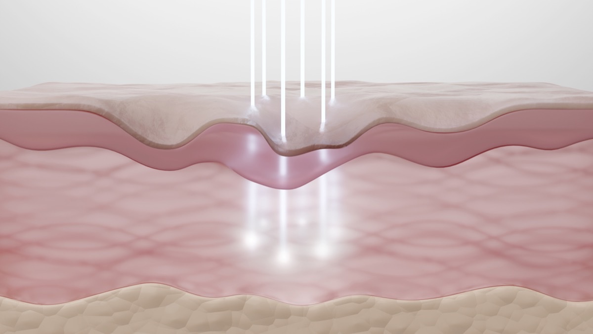 医療美容のRFニードル施術の仕組みを図解したイラスト。ブレッシングとポテンツァの違いが分かるイメージ。