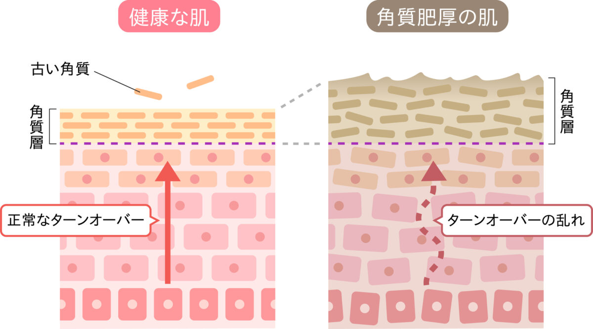 角層のバリア機能とは？仕組みを解説